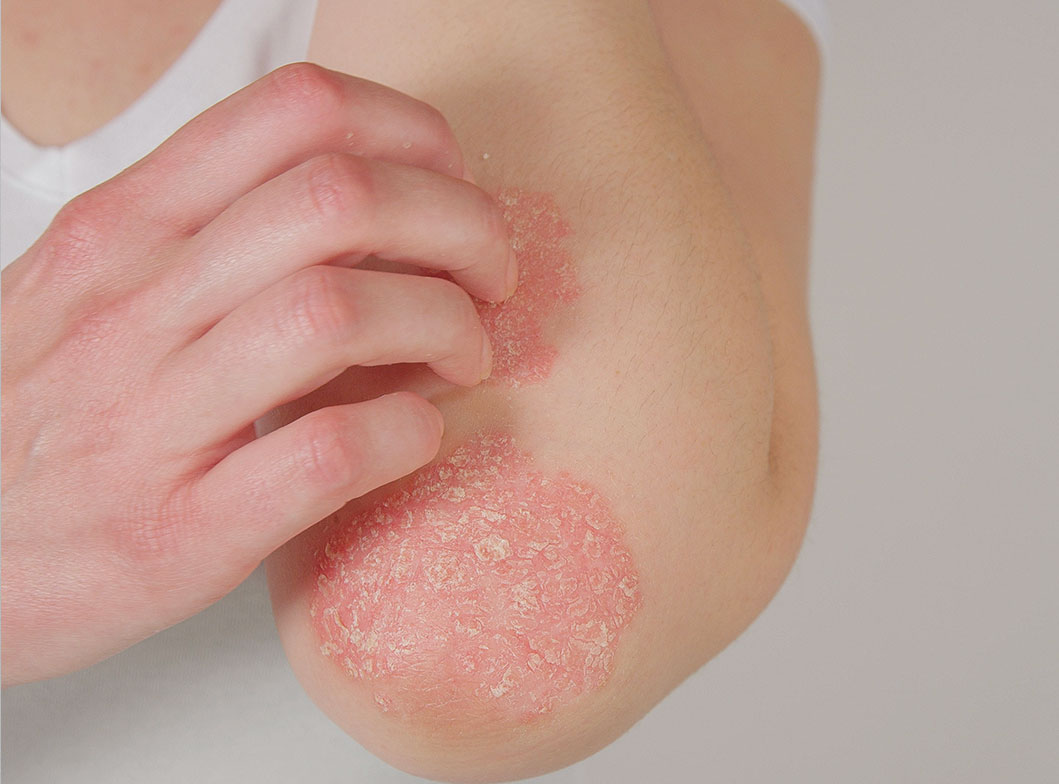 Acne Treatment Options